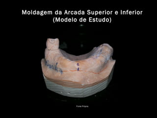 Moldagem da Arcada Superior e Inferior
(Modelo de Estudo)
Fonte Própria
 