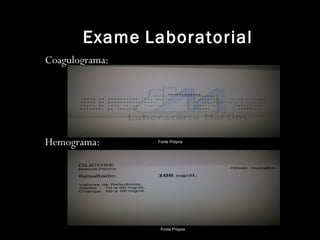Exame Laboratorial
Coagulograma:
Hemograma: Fonte Própria
Fonte Própria
 