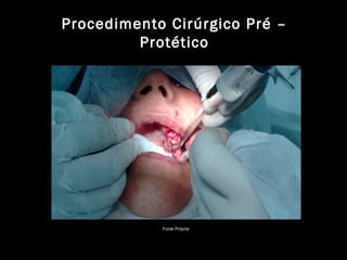 Procedimento Cirúrgico Pré –
Protético
Fonte Própria
 