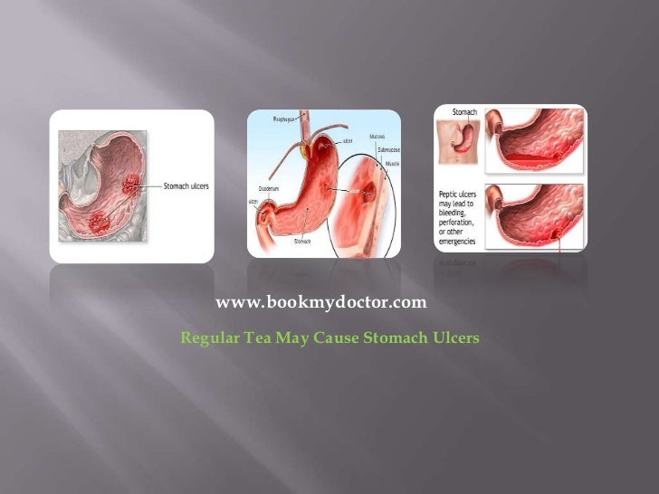 Regular Tea May Cause Stomach Ulcers regular-tea-may-cause-stomach-ulcers