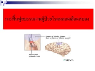 การฟื้นฟูสมรรถภาพผู้ป่วยโรคหลอดเลือดสมอง
 