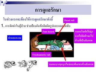 การดูแลรักษา
 ในช่วงแรกจะต้องให้การดูแลรักษาดังนี้              Hand roll
1. การจัดท่าในผู้ป่วย ช่วยป้องกันข้อติดผิดรูปและแผลกดทับ
                                  Foot board                   หมอนใบเล็กไม่สูง
                                                               มากไปจัดศีรษะไป
     ท่านอนหงาย
                                                               ด้านที่เป็นอัมพาต


                         Trochanteric roll

                                        หมอนบางๆหนุนไหล่และต้นแขนข้างอัมพาต
 