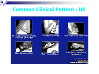 Common Clinical Pattern : UE
 