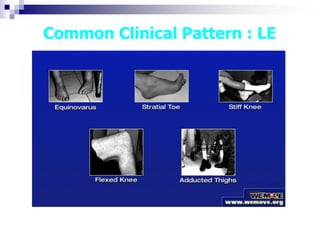 Common Clinical Pattern : LE
 