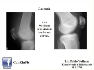Rotula Mutata Rehabilitación en las distintas Fracturas de Rótula.PDF