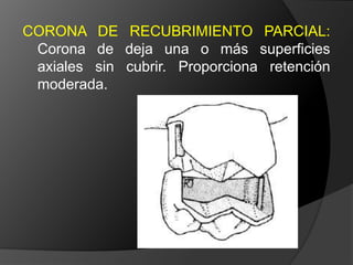 ONLAY MOD: Lesiones  moderadamente grandes en premolares y molares con superficie s vestibularesintactas. 	Si hay un reborde marginal comprometido es necesario el recubrimiento cuspídeo. No debe ser utilizado como retenedor de P.P.F.		