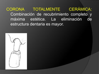 CORONA DE RECUBRIMIENTO PARCIAL: Corona de deja una o más superficies axiales sin cubrir. Proporciona retención moderada.