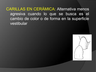 CORONA COMPLETA EN METAL: 	En dientes con múltiples superficies axiales defectuosas o destruidas. Proporciona la máxima retención.	La superficie oclusal	favorece  el chequeo oclusal