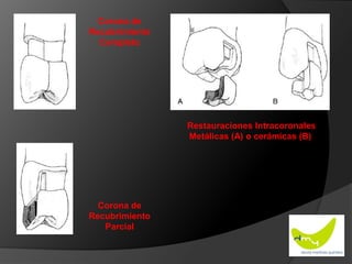 CORONA COMPLETA METAL-CERÁMICA: Iguales indicaciones que la metálica pero  estética