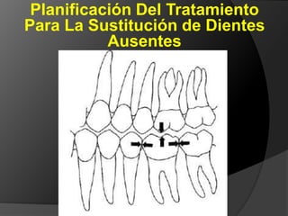 CARILLAS EN CERÁMICA: Alternativa menos agresiva cuando lo que se busca es el cambio de color o de forma en la superficie vestibular