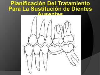 Planificación Del Tratamiento Para La Sustitución de Dientes Ausentes