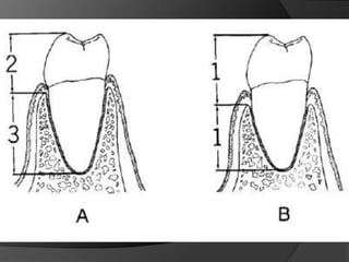 Planificación Del Tratamiento Para La Sustitución de Dientes Ausentes