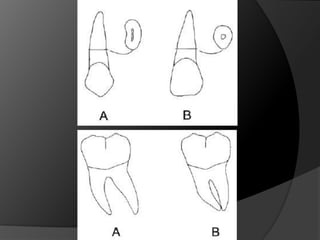 Planificación Del Tratamiento Para La Sustitución de Dientes Ausentes