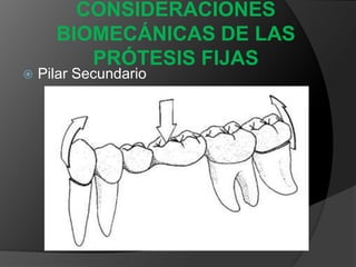 CONSIDERACIONES BIOMECÁNICAS DE LAS PRÓTESIS FIJASCimbreo o Deflexión