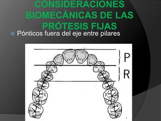 CONSIDERACIONES BIOMECÁNICAS DE LAS PRÓTESIS FIJASCimbreo o Deflexión