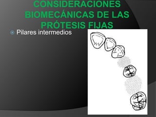 Las fuerzas de desalojo  en una restauración simple actuarán en dirección vestíbulolingualLas fuerzas de desalojo sobre un P.P.Fija tienden a actuar  con una dirección mesiodistalv.s.Debido a las fuerzas aplicadas a los dientes pilares a través del póntico, las fuerzas sobre los colados que sirven como retenedores para P.P.F.  son diferentes en magnitud y dirección de las que se aplican a restauraciones simples