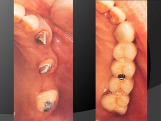 CONSIDERACIONES BIOMECÁNICAS DE LAS PRÓTESIS FIJASPónticos fuera del eje entre pilares 
