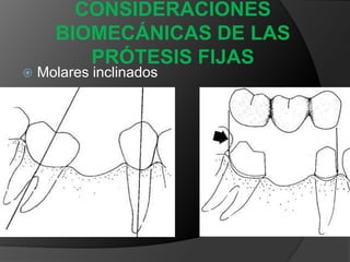 CONSIDERACIONES BIOMECÁNICAS DE LAS PRÓTESIS FIJASPilares intermedios
