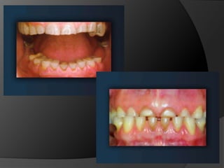 CONSIDERACIONES BIOMECÁNICAS DE LAS PRÓTESIS FIJASPrótesis Parciales Fijas en Cantilever