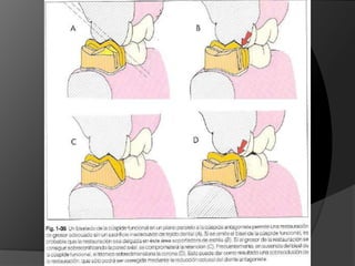 Reducción OclusalCorona en oro:     1,5 mm cúspide funcional				       1,0 mm cúspide no funcionalCorona en metales duros: 			       1,3 mm cúspìde funcionalCorona cerámica: 2,0 mm cúspide funcional				        1,5 mm cúspide no funcional
