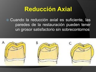 Si la superficie oclusal se hace plana, el metal en el área del surco de desarrollo será demasiado fino, con riesgo de perforación