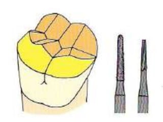 CORONAS DE RECUBRIMIENTO  COMPLETOEstá indicada cuando se necesita máxima protección dental y máxima retención