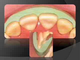 CORONAS DE RECUBRIMIENTO COMPLETOMetal Cerámica: Son una combinación de 	un material cerámico de recubrimiento y 	una subestructura metálicaEn los años 50s se desarrolló la primera aleación oro-porcelana comercialmente exitosa