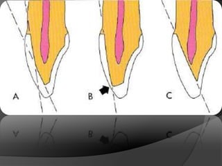 CORONAS DE RECUBRIMIENTO COMPLETOMetal Cerámica: Capa delgada de porcelana opacaPorcelana de CuerpoPorcelana Translúcida