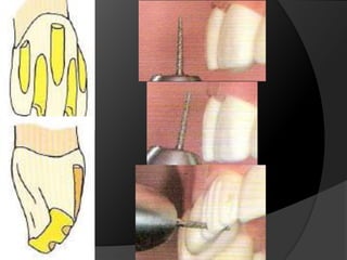 CORONAS DE RECUBRIMIENTO COMPLETOMetal Cerámica: Metal: Grosor de 0,3 mm a 0,5 mmCerámica: Grosor 1mm aprox.