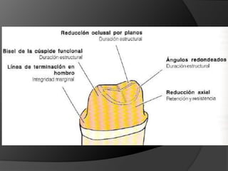 CORONAS DE RECUBRIMIENTO COMPLETOCerámica:Coronas jacket de porcelana: Cerámica feldespáticaIncisal: 2mm de desgasteAxial Vestibular : 1 mm de desgasteLingual: 0,5 mm a 1 mm de desgaste