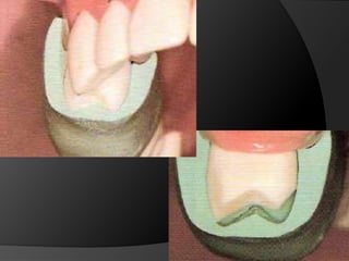 CORONAS DE RECUBRIMIENTO PARCIAL - ¾ SUPERIORESRestauración conservadoraPermiten evaluar con exactitud asentamiento de márgenesFácil escape del material cementanteLa pared no tallada sirve como guía de fabricación de contornosPermite pruebas de vitalidad pulparEstética en veremos