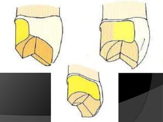 CORONAS DE RECUBRIMIENTO PARCIAL - ¾ SUPERIORESIndicaciones:Superficie vestibular intacta (Esmalte-Dentina)Porcentaje de caries mínimoDiente de longitud suficienteBuena higieneNecesidad estética baja o moderada