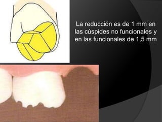 ¾ ANTERIORESRequieren más  tiempo y destreza que para coronas completas y no son para todos los dientes ni para todos los pacientesIndicación: En puentes cortos con pilares relativamente libres de restauraciones y de caries. Contraindicado en sobremordidas profundas