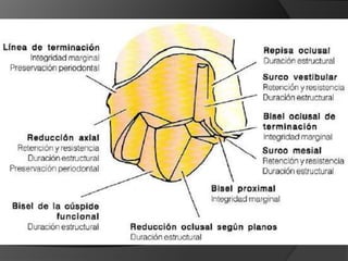 CORONAS DE RECUBRIMIENTO PARCIAL – 7/8Indicaciones:Dientes con cúspide MV intacta pero con restauracionesPrimeros molares superiores, con restauración extensa distal o distovestibularRetención y resistencia significativamente mayor que la corona 3/4