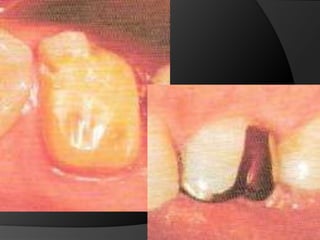 La reducción es de 1 mm en las cúspides no funcionales y en las funcionales de 1,5 mm