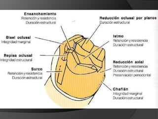 CORONAS DE RECUBRIMIENTO PARCIAL – Media Corona ProximalUn problema especialmente complejo es el de un molar inferior inclinado que va a ser pilar de prótesis fijaCuando el diente en perspectiva de ser pilar está inclinado hacia el espacio edéntulo, ya no es posible que su trayectoria de inserción sea a la vez paralela al eje longitudinal del diente y perpendicular al plano de oclusión