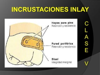 INCRUSTACIONES INLAYCLASEII