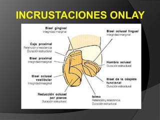 INCRUSTACIONES INLAYCLASEIII