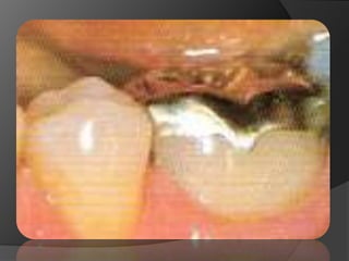 INCRUSTACIONES INLAYCLASEV