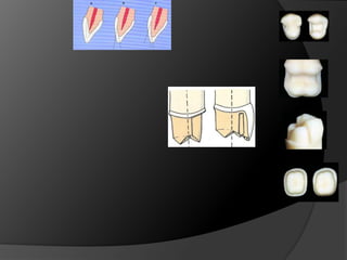 INCRUSTACIONES ONLAY