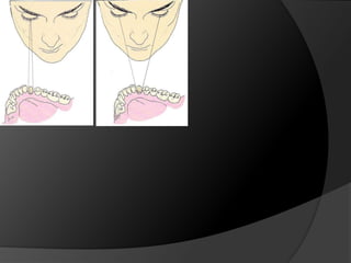 INCRUSTACIONES ONLAY