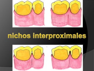 nichos interproximales