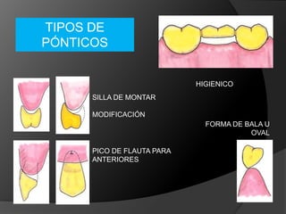 TIPOS DE PÓNTICOSHIGIENICOSILLA DE MONTARMODIFICACIÓNFORMA DE BALA U OVALPICO DE FLAUTA PARA ANTERIORES