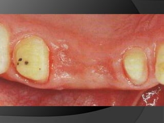 Superficie oclusal restablecida igual a la que sustituyeFundamentos de Biomecánica en Prótesis Fija¿ Cómo la prótesis puede presentar longevidad satisfactoria si el diente preparado no presenta condiciones mecánicas para mantenerla en posición, si el desgaste fue exagerado y alteró la biología pulpar, si la terminación cervical fue llevada muy subgingivalmente y si la estética fue perjudicada debido a un desgaste inadecuado ?