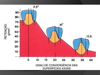 Características que impidan el dislocamiento axial de la restauración cuando es sometida a fuerzas de tracciónRetención Friccional (Paralelismo)vs.Agente CementanteUbicación de Surcos de Retención 