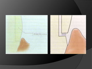 PRINCIPIOS MECÁNICOSRetenciónResistencia o EstabilidadRigidez EstructuralIntegridad Marginal 