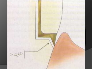 HOMBRO O ESCALÓN: Es un tipo de terminación donde la pared axial de la preparación forma un ángulo de aproximadamente 90º con la pared cervical	Indicación: Coronas de porcelana pura o M/P con terminación V en porcelana	Contra:  Exige mayor desgasteDificulta el escurrimiento del cemento
