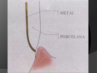 HOMBRO O ESCALON BISELADO: Es un tipo de terminación en la que se da la formación de un ángulo de aprox. 90º entre las paredes axial y cervical, con biselado de la arista cavo-superficial. Biselado de 45ºIndicación: Coronas M/P en aleación semi o preciosa	Se disminuye el desajuste marginalFresa: Troncocónica de punta plana