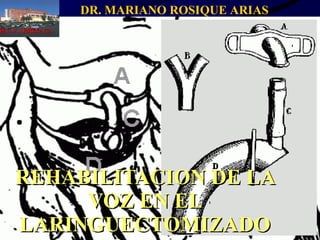 REHABILITACION DE LA VOZ EN EL LARINGUECTOMIZADO DR. MARIANO ROSIQUE ARIAS H.U.V.ARRIXACA 