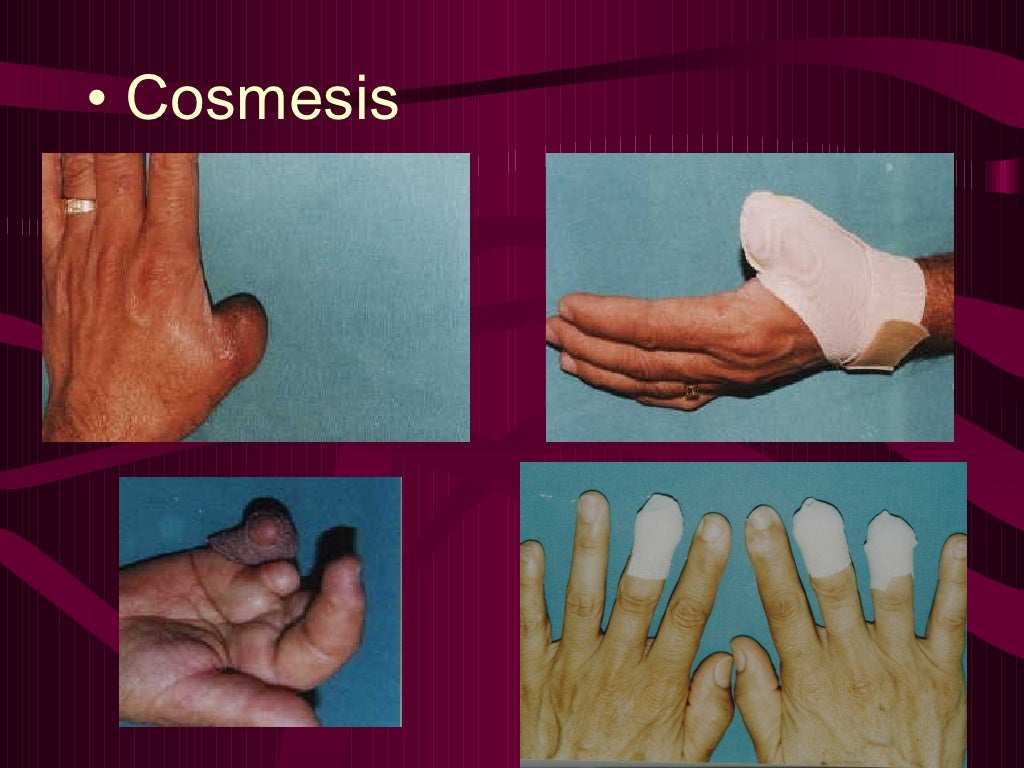 Hand Therapist Rehabilitation of Fingertip Injuries